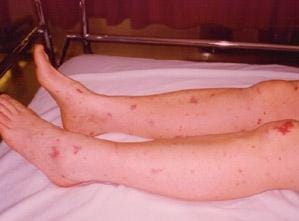 Legs with a mild red rash on them